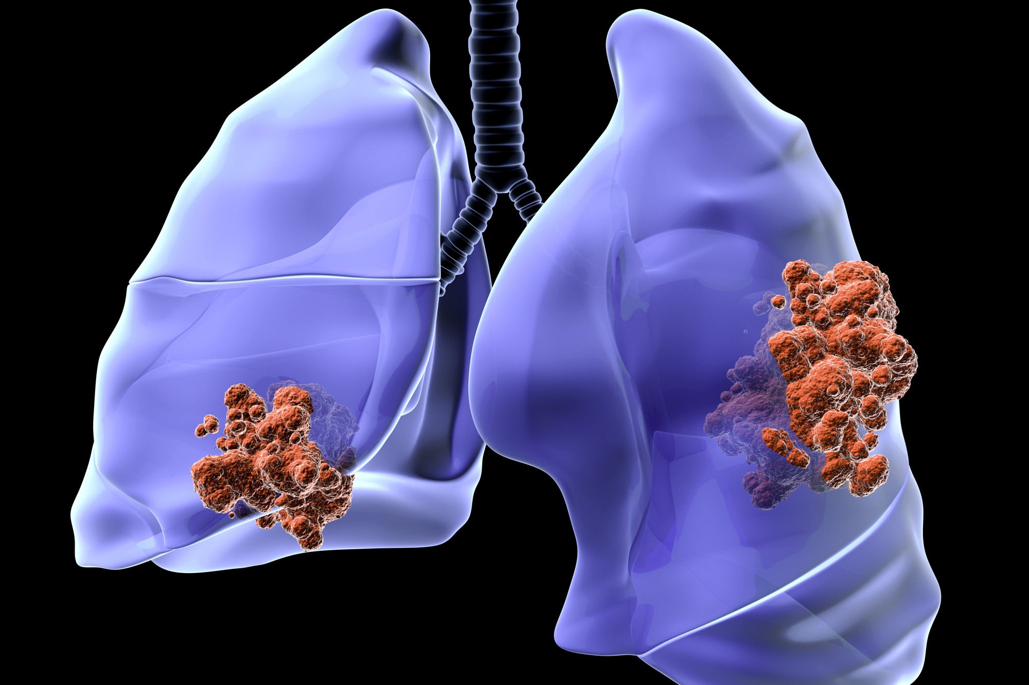 Nodule Pulmonaire SOS MEDECINS DOMICILE CASA 06 61 14 09 81 — free download